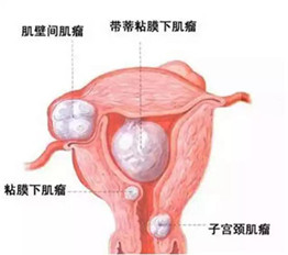 子宫肌瘤千万不能割，谁割谁后悔